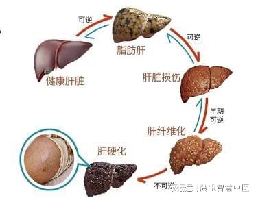 脂肪肝患者的食疗养生措施，中医养生的智慧